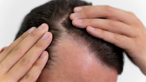How Can You Prevent Hair Loss?