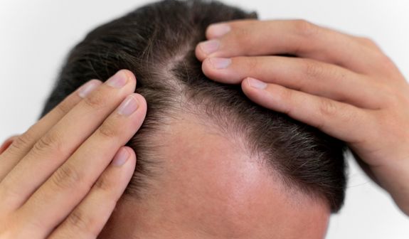 How Can You Prevent Hair Loss?